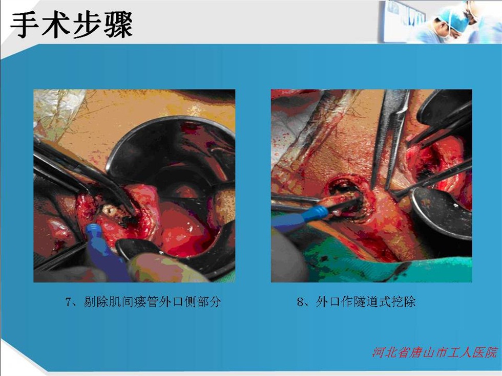 [項目展示]肛瘻lift(經括約肌間瘻管結紮術)技術的推廣 中國基層衛生